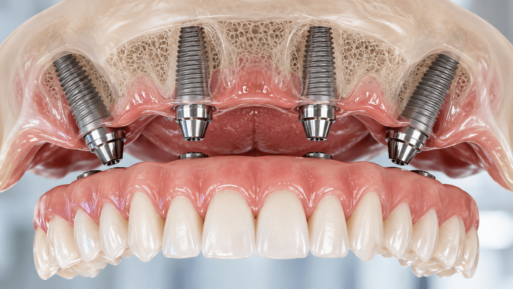 Réhabilitation complète All-on-4 sur implants