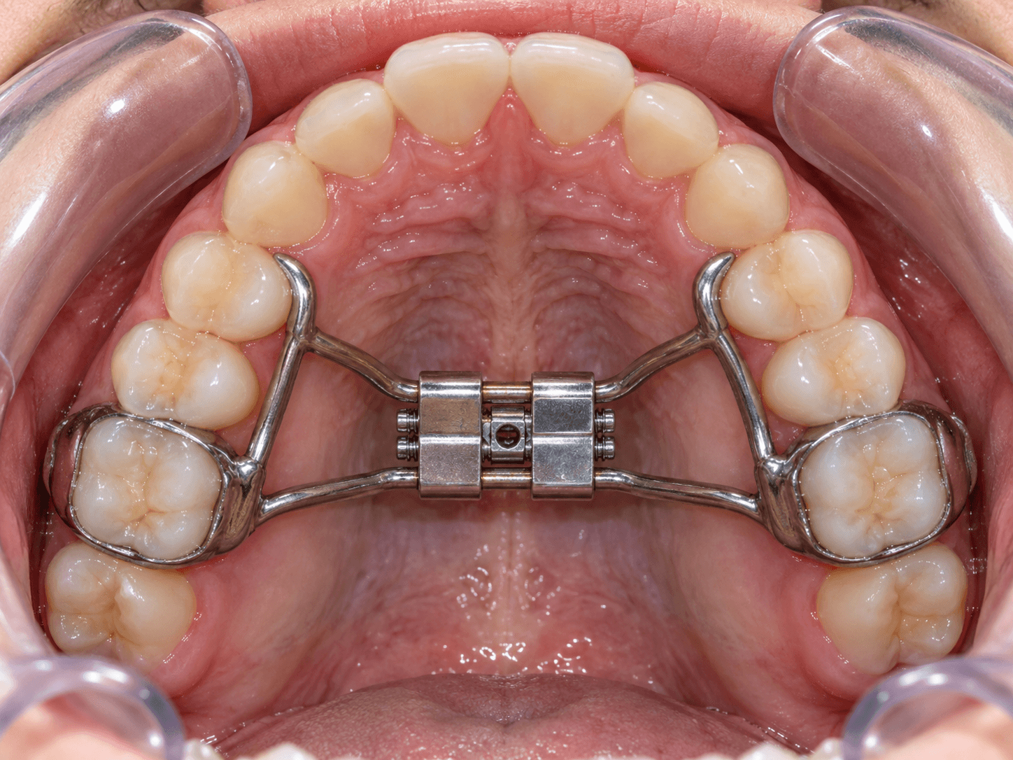 Exemple de disjoncteur orthodontique au palais