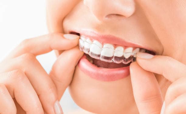Invisalign et aligneurs transparents